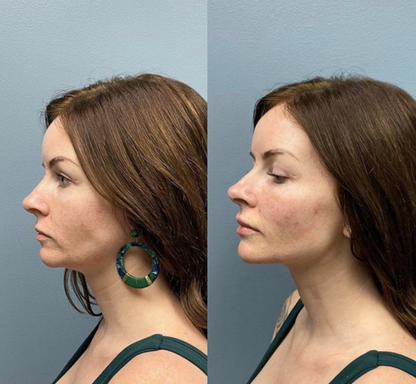 Porefect® Lymphatic Contour Face Brush